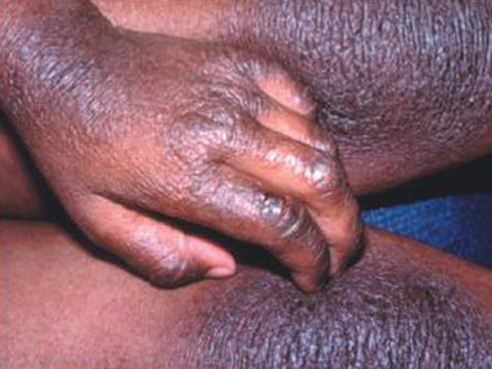Atopic Dermatitis