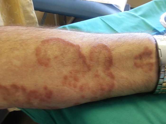 Skin Scrape