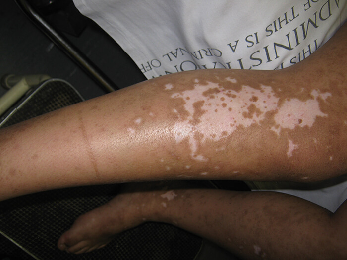 Pigmentation Disorders