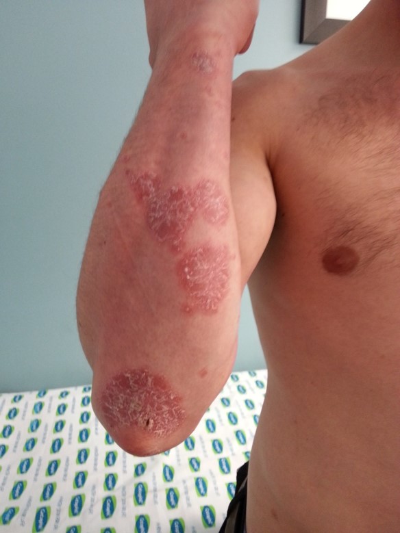 Psoriasis