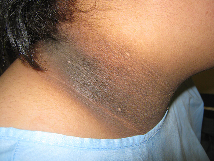 Acanthosis Nigricans