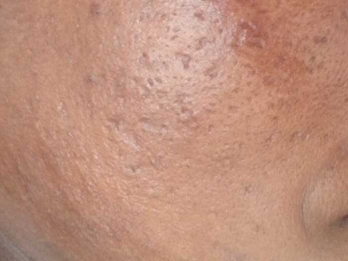 Acne Scarring
