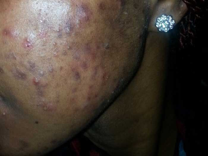 Acne Vulgaris 4
