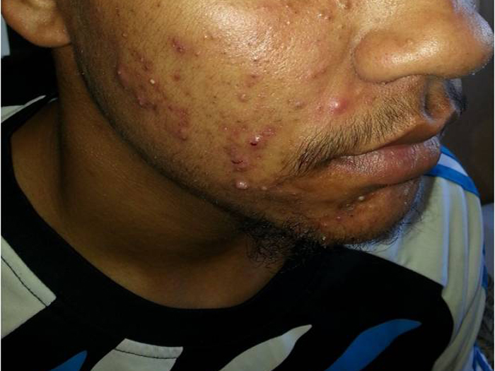 Acne Vulgaris