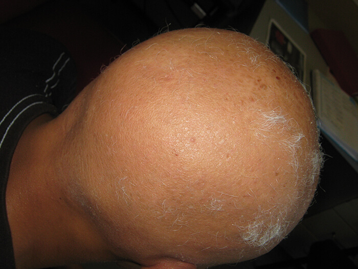 Alopecia Areata 1
