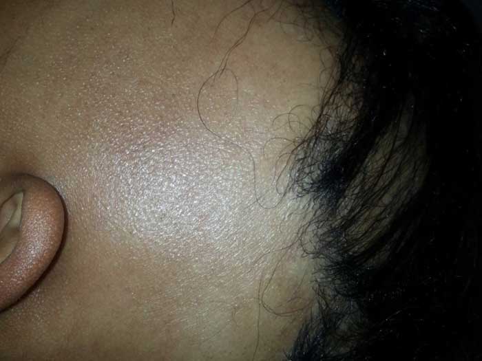 Alopecia Areata 2