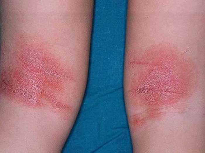Atopic Dermatitis 2 1