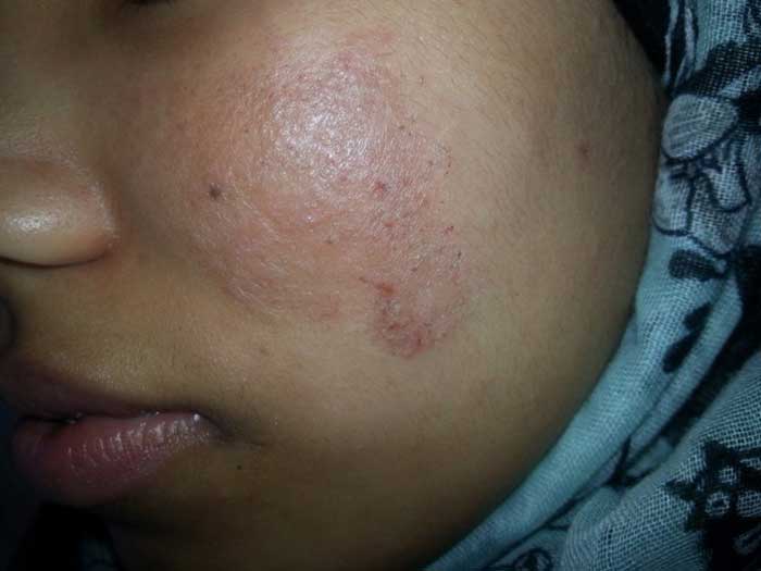 Atopic Dermatitis 3 1