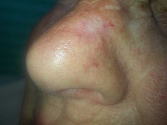 Basal Cell Carcinoma 1