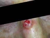 Basal Cell Carcinoma 2 Tiny