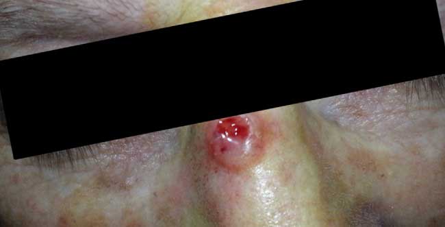 Basal Cell Carcinoma 2