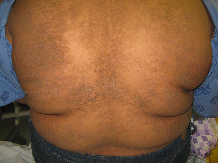 Confluent And Reticulated Papillomatosis