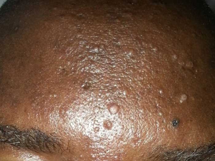 Cryptococosis