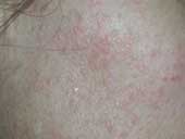 Flat Warts Tiny