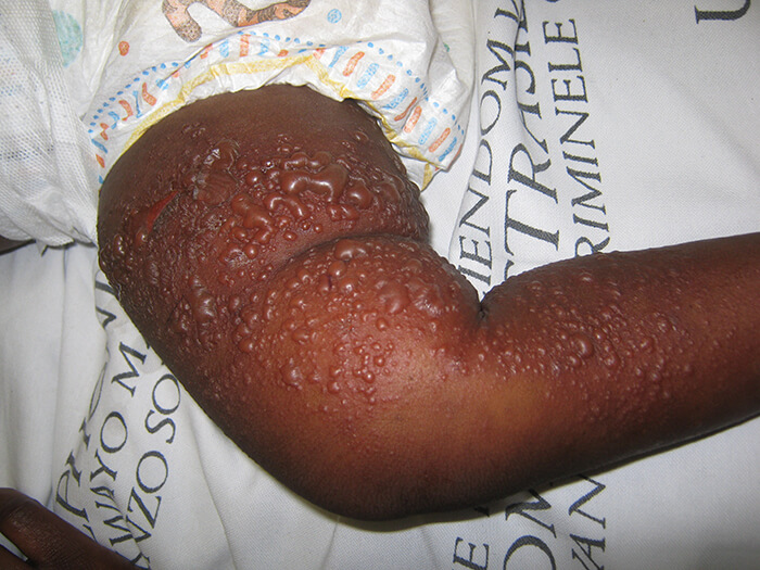 Irritant Contact Dermatitis 1