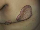 Keloids Tiny