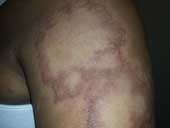 Leprosy Tiny