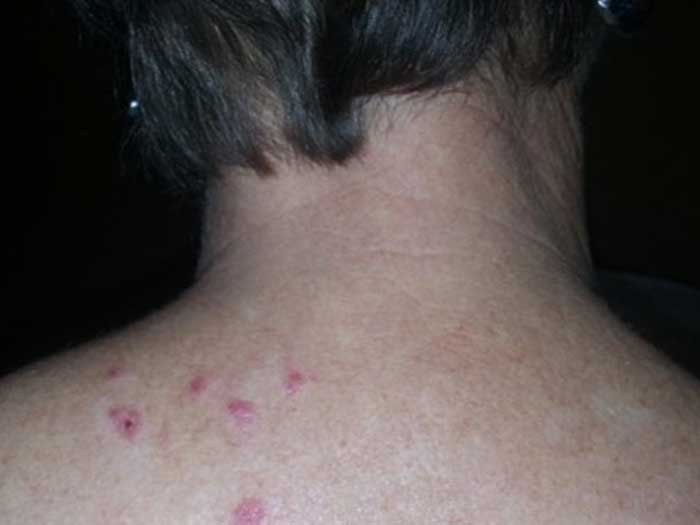 Lupus Erythematosus