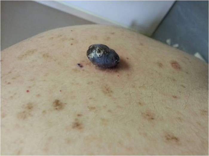 Malignant Melanoma