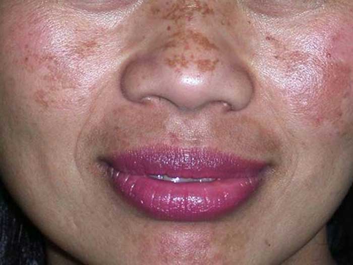 Melasma