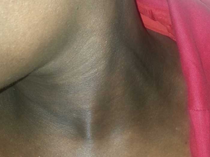 Pigmentation Disorders 2