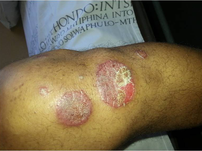 Psoriasis 2 1