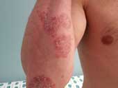 Psoriasis 3 Tiny