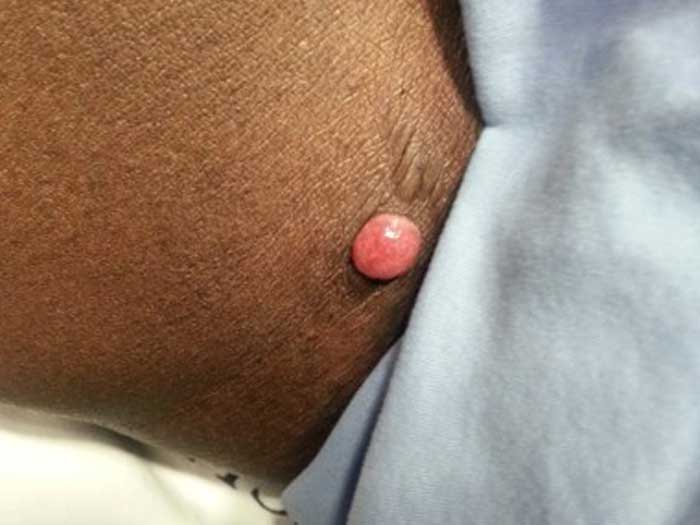Pyogenic Granuloma