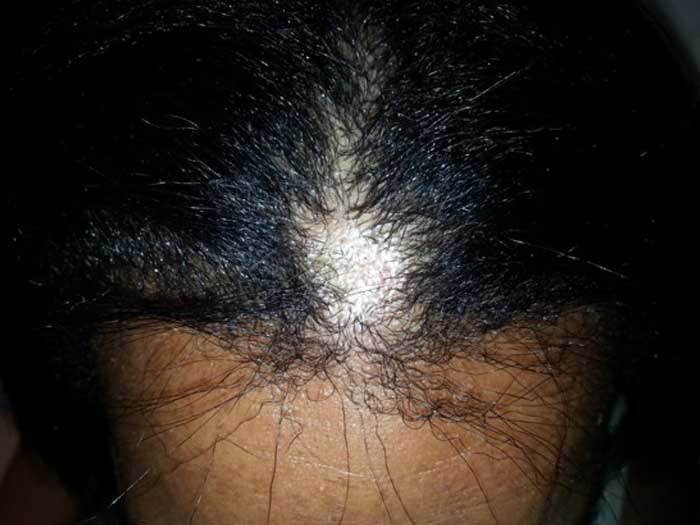 Scarring Alopecia 2