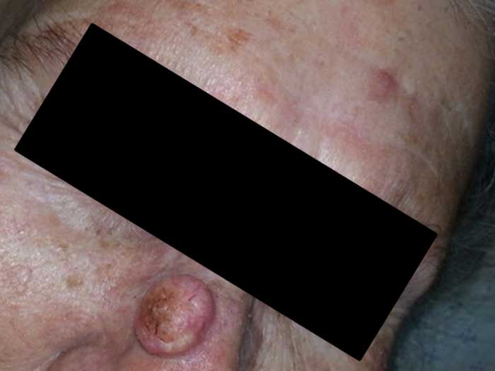 Squamous Carcinoma