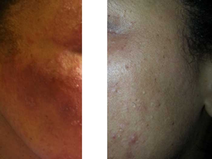 Steroid Induced Acne