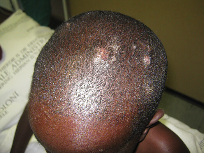 Tinea Capitis