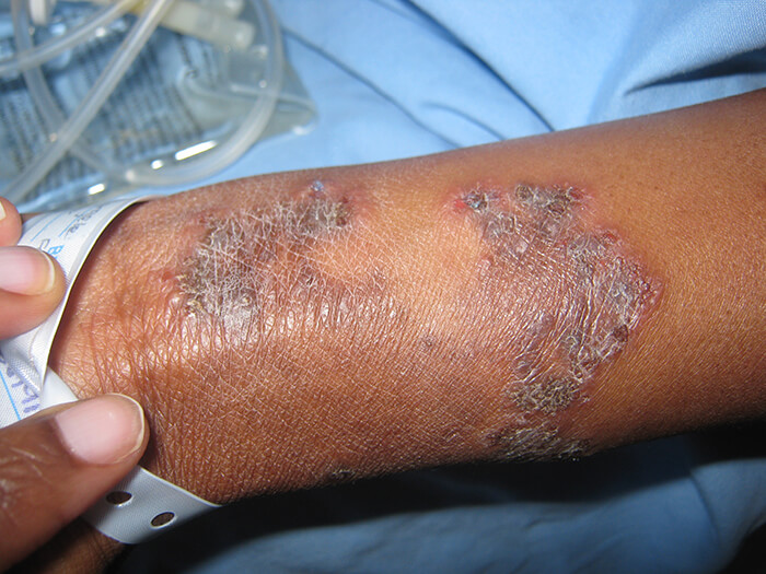 Tinea Corporis