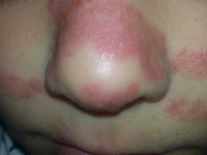 Tinea Faciei