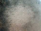 Traction Alopecia Tiny