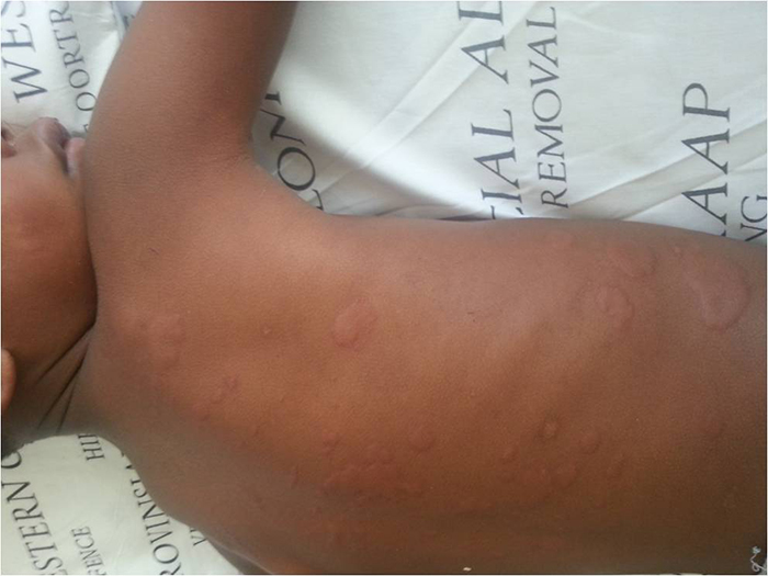 Urticaria