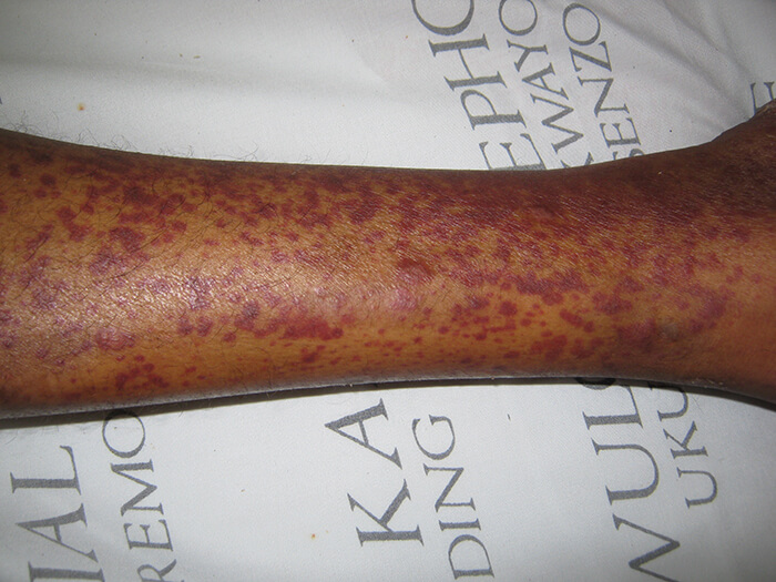 Vasculitis